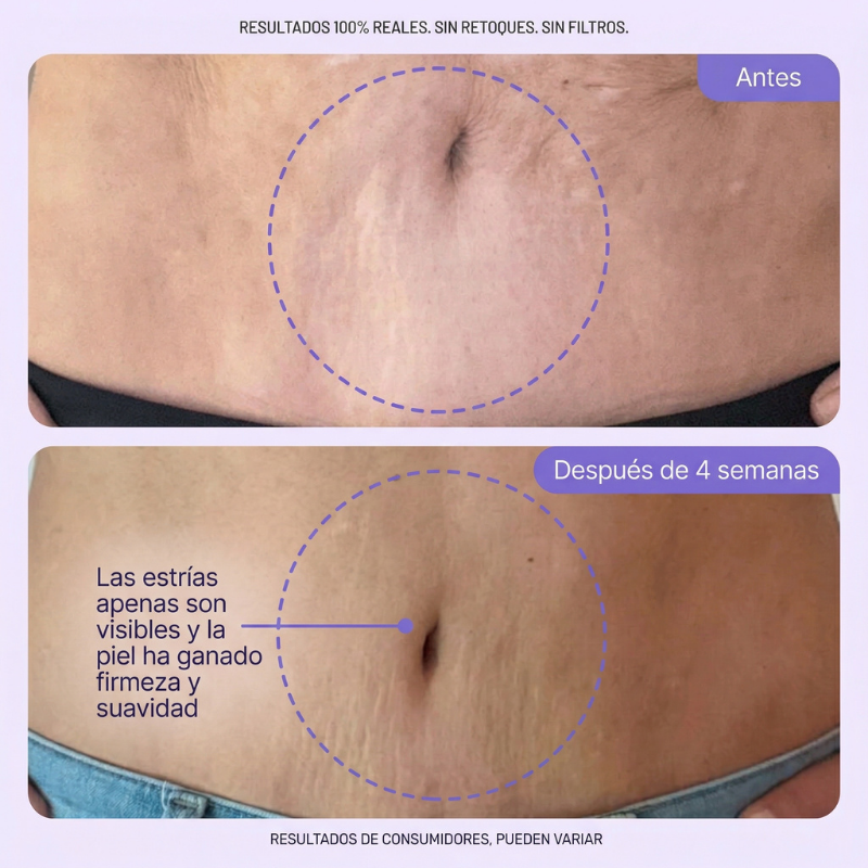 Crema reafirmante antiestrías