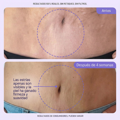 Crema reafirmante antiestrías