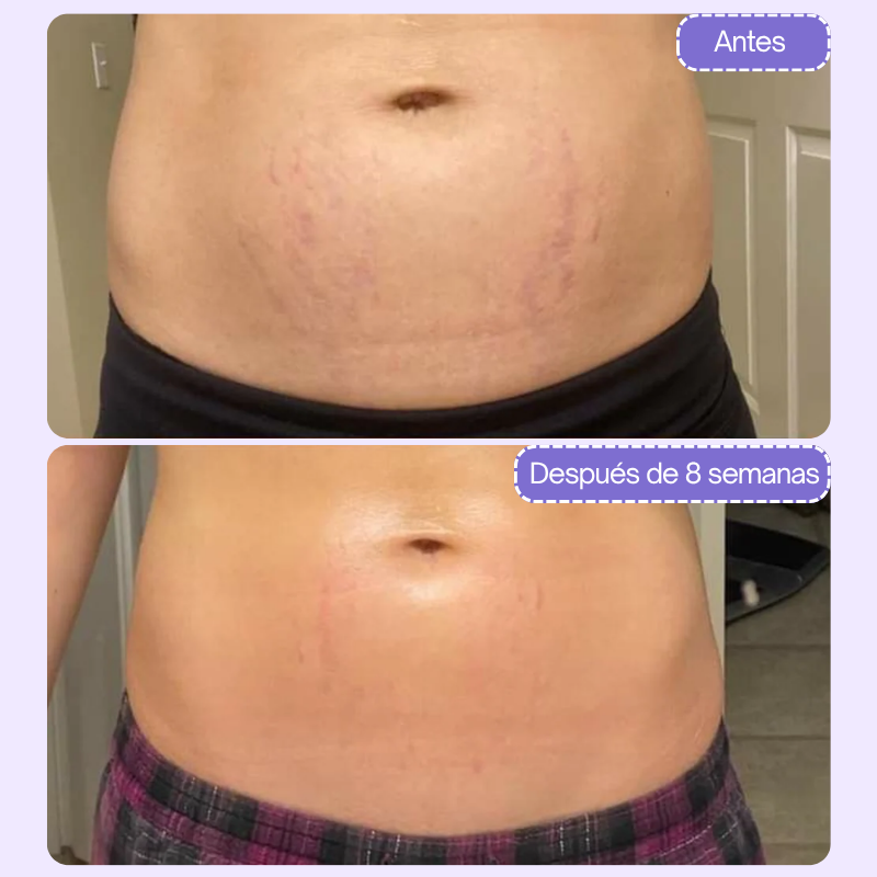 Crema reafirmante antiestrías
