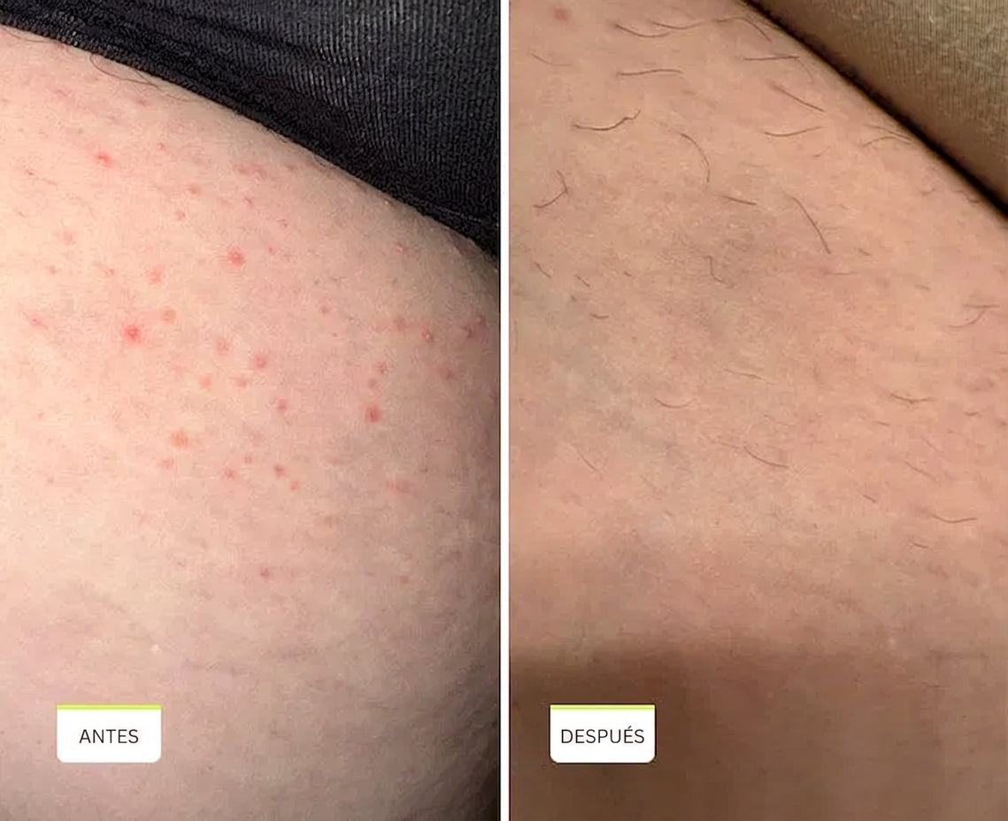 Smoothing Solution — Aclarador de Axilas, Ingles y Línea del Bikini